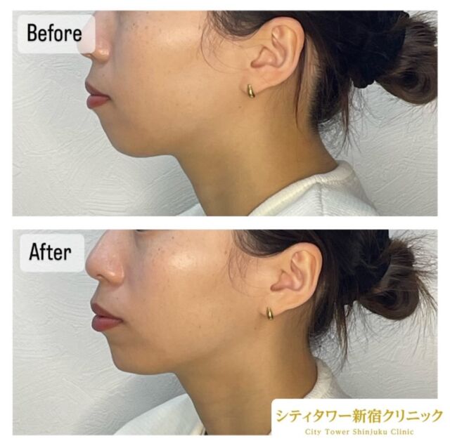 今回は顎ヒアルロン酸の注入症例です💁🏼‍♀️

顎にヒアルロン酸を注入することにより、スッキリとした輪郭を作ったり、綺麗な横顔を作ることが可能です🌷✨

お好みに合わせて形を調整いたしますので、お気軽にご相談ください🧚🏻‍♀️
顎のボトックスと合わせることでよりシュッとした印象になるのでおすすめです😆💎

———————————
ヒアルロン酸
リスク:内出血、感染、腫れ
料金:ヒアルロン酸　0.1cc¥10,000
　　　　　1cc 1本購入　¥80,000

#美容皮膚科#美容#美容外科#形成外科#皮膚科#新宿クリニック#西新宿#中野坂上#シティタワー#新宿#ほくろ#いぼ#炭酸ガスレーザー#CO2#フォトフェイシャル#ルクセア#脱毛#医療脱毛#ボトックス#ヒアルロン酸#美容点滴#美容注射#水光注射#分子栄養#二重埋没#二重切開#若返り美容#コースメニュー#アンチエイジング化粧品