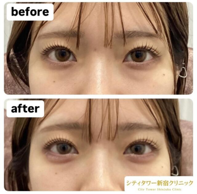 涙袋ヒアルロン酸の症例です😌🌷

涙袋にヒアルロン酸を注入することにより、可愛らしい印象を作り上げたり、中顔面を短く見せたり、目元のシワを目立ちにくくすることができます🫶🏻

ナチュラルな涙袋をご希望の方、はっきりとした涙袋ご希望の方、一人一人のお好みに合わせてヒアルロン酸量を調整するので、お気軽にご相談ください🥰

—————————
ヒアルロン酸
リスク:内出血、感染、腫れ
料金:ヒアルロン酸　0.1cc¥10,000
　　　　　1cc 1本購入　¥80,000

#美容皮膚科#美容#美容外科#形成外科#皮膚科#新宿クリニック#西新宿#中野坂上#シティタワー#新宿#ほくろ#いぼ#炭酸ガスレーザー#CO2#フォトフェイシャル#ルクセア#脱毛#医療脱毛#ボトックス#ヒアルロン酸#涙袋#美容点滴#美容注射#水光注射#分子栄養#二重埋没#二重切開#若返り美容#涙袋#涙袋ヒアルロン酸#アンチエイジング