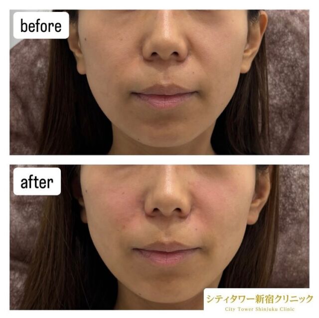 ほうれい線のヒアルロン酸注入の症例です💁🏼‍♀️✨

ヒアルロン酸はナチュラルにお顔の印象を変えることができるので、大人気施術のひとつです🌈

ほうれい線は加齢に伴い目立ちやすくなったり、骨格によって目立ちやすい方もいらっしゃいます。気になっている部分に少量注入するだけも効果を実感して頂けます💎

一人一人お悩みに合わせてヒアルロン酸量を調整するので、お気軽にご相談ください☺️🩵
————————————
ヒアルロン酸
リスク:内出血、感染、腫れ
料金:ヒアルロン酸　0.1cc¥10,000
　　　　　1cc 1本購入　¥80,000

#美容皮膚科#美容#美容外科#形成外科#皮膚科#新宿クリニック#西新宿#中野坂上#シティタワー#新宿#ほくろ#いぼ#炭酸ガスレーザー#CO2#フォトフェイシャル#ルクセア#脱毛#医療脱毛#ボトックス#ヒアルロン酸#美容点滴#美容注射#水光注射#ほうれい線ヒアルロン酸二重埋没#二重切開#若返り美容#コースメニュー#アンチエイジング化粧品#ほうれい線改善