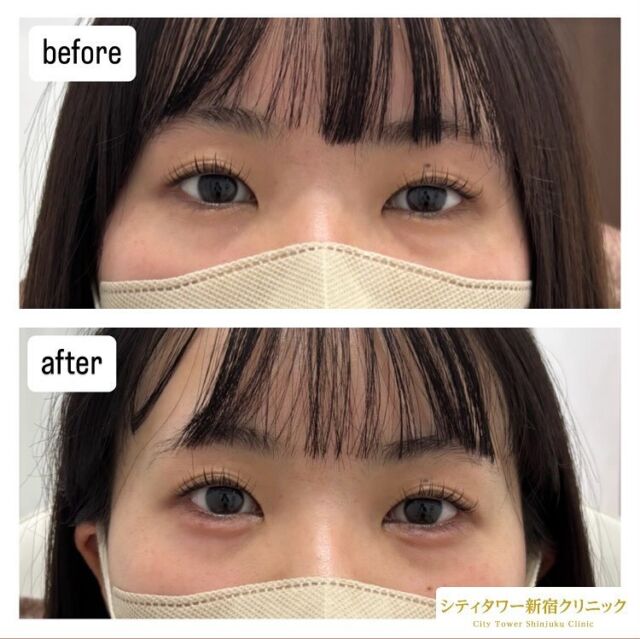 涙袋ヒアルロン酸の症例です🐻‍❄️🌿

涙袋にヒアルロン酸を注入することにより、優しく可愛らしい印象を作り出せます🥰そして目の縦幅を大きく見せることができるので、中顔面短縮の効果もあります🌷✨

ナチュラルな涙袋をご希望の方、はっきりとした涙袋ご希望の方、一人一人のお好みに合わせてヒアルロン酸量を調整するので、お気軽にご相談ください💚

—————————
ヒアルロン酸
リスク:内出血、感染、腫れ
料金:ヒアルロン酸　0.1cc¥10,000
　　　　　1cc 1本購入　¥80,000

#美容皮膚科#美容#美容外科#形成外科#皮膚科#新宿クリニック#西新宿#中野坂上#シティタワー#新宿#ほくろ#いぼ#炭酸ガスレーザー#CO2#フォトフェイシャル#ルクセア#脱毛#医療脱毛#ボトックス#ヒアルロン酸#涙袋#美容点滴#美容注射#水光注射#分子栄養#二重埋没#二重切開#若返り美容#涙袋#涙袋ヒアルロン酸#アンチエイジング