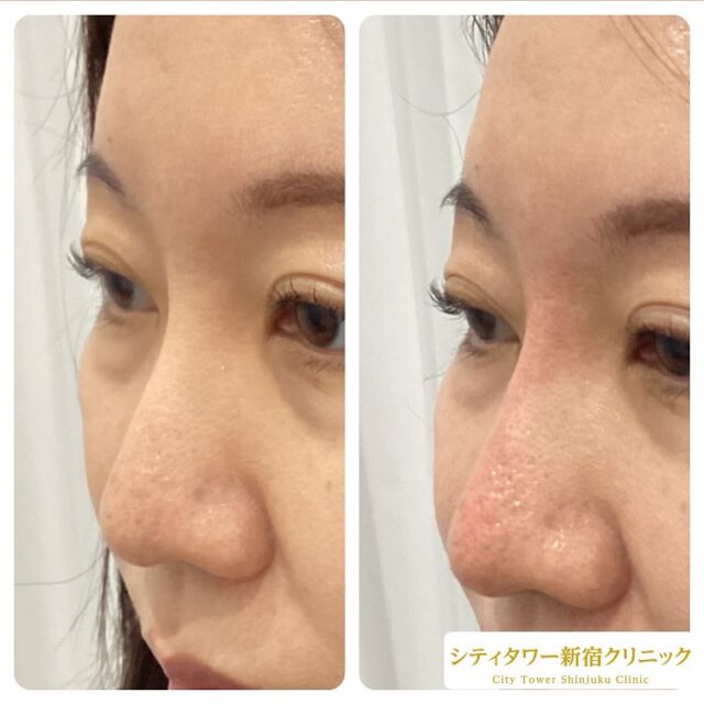 鼻のヒアルロン酸注入の症例です💁🏼‍♀️✨

ヒアルロン酸はナチュラルにお顔の印象を変えることができるので、大人気施術のひとつです🌷🌷

鼻筋と鼻先に注入し、よりハッキリとした印象になりました😊✨

気になっている部分に少量注入するだけも効果を実感して頂けます‼︎

一人一人お悩みに合わせてヒアルロン酸量を調整するので、お気軽にご相談くださいね☺️💚
————————————
ヒアルロン酸
リスク:内出血、感染、腫れ
料金:ヒアルロン酸　0.1cc¥10.000
　　　　　1cc 1本購入　¥80.000

#美容皮膚科#美容#美容外科#形成外科#皮膚科#新宿クリニック#西新宿#中野坂上#シティタワー#新宿#フォトフェイシャル#ルクセア#脱毛#医療脱毛#ボトックス#ヒアルロン酸#美容点滴#美容注射#水光注射#分子栄養#二重埋没#二重切開#若返り美容#コースメニュー#アンチエイジング化粧品#鼻ヒアルロン酸