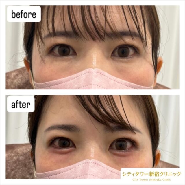 今回ヒアルロン酸（涙袋）の症例です🥰

こんなお悩みがある方！是非ご相談ください🌷

————————————
ヒアルロン酸
リスク:内出血、感染、腫れ
料金:ヒアルロン酸　0.1cc¥10.000
　　　　　1cc 1本購入　¥80.000

#美容皮膚科#美容#美容外科形成外科皮膚科新宿クリニック西新宿中野坂上シティタワー新宿ほくろいぼ炭酸ガスレーザーCO2フォトフェイシャルルクセア脱毛医療脱毛ボトックスヒアルロン酸美容点滴美容注射水光注射分子栄養二重埋没二重切開若返り美容コースメニューアンチエイジング化粧品